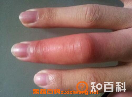 被蜜蜂蛰了怎么处理 被蜜蜂蛰了怎么办