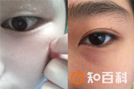 【图】甘油去除脂肪粒有用吗 关于它有些事你不得不知