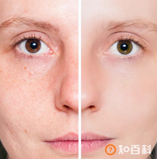 【图】毛孔粗有黑头怎么办 吃什么很重要