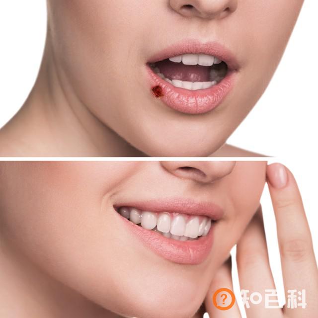 【图】嘴唇上长泡能挖破么  嘴部水泡处理方法