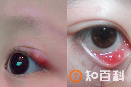 【图】一旦眼睛起了麦粒肿怎么办 掌握治疗方法非常重要