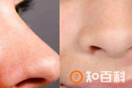 【图】分析黑头怎么形成的 教你有效的方法一招致胜