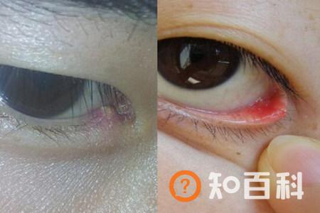 【图】一旦眼睛起了麦粒肿怎么办 掌握治疗方法非常重要