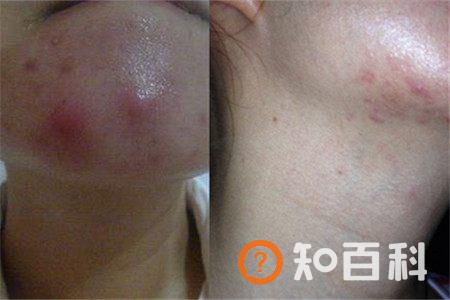 【图】下巴长硬疙瘩能挤吗 千万不能这样子做