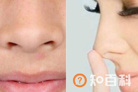 【图】分析黑头怎么形成的 教你有效的方法一招致胜