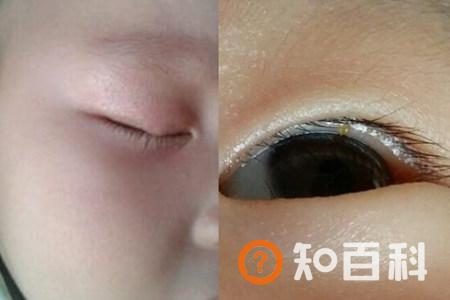 【图】一旦眼睛起了麦粒肿怎么办 掌握治疗方法非常重要