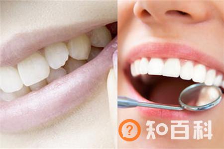 【图】牙根出血怎么办 分清病因轻松治愈