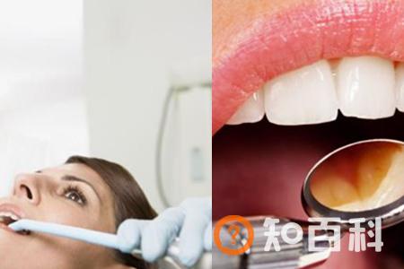 【图】如何快速清除牙石 远离烟酒定期洗牙