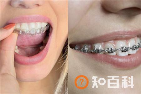 【图】矫正牙齿会改变脸型吗 这些你应该了解