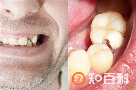 【图】牙根有个洞   到底是哪些原因造成的
