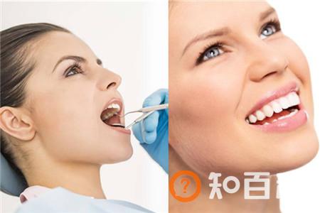 【图】洗牙后的注意事项  保护牙齿的好方法