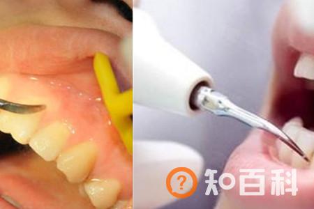 【图】如何清除牙石 简单快捷的小妙招