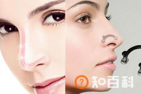 【图】收鼻翼有什么副作用吗  哪些人不适合做