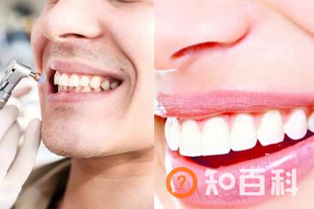 【图】了解洗牙的利与弊 助你做出正确选择