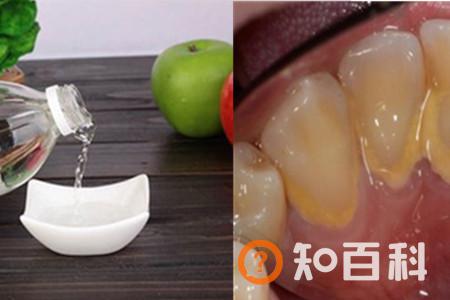 【图】如何清除牙石 简单快捷的小妙招