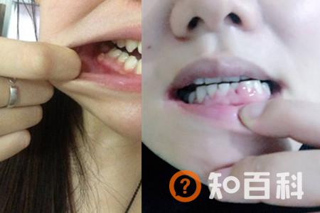 【图】牙根有个洞   到底是哪些原因造成的