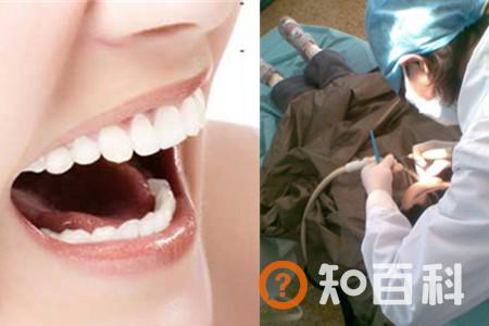 【图】洗牙好不好  它和牙齿美白是一回事吗