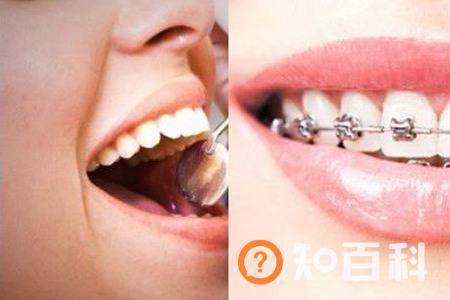 【图】暴牙的图片展示  强烈推荐几种矫正方法