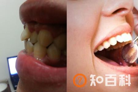 【图】暴牙的图片展示 教你几种恢复方法