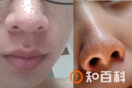 【图】怎样让鼻头变小 哪些方法可以参考