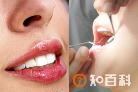 【图】清除牙石牙齿会损坏吗 说说洗牙的好处