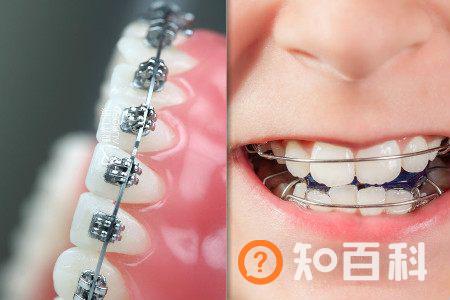 【图】暴牙的图片展示  强烈推荐几种矫正方法