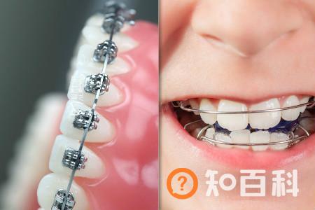 【图】暴牙的图片展示 教你几种恢复方法