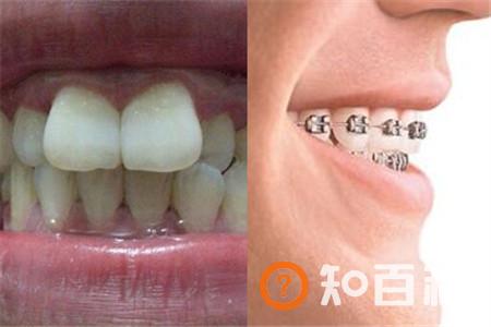 【图】暴牙修复后面部会发生微妙变化  可以提升颜值