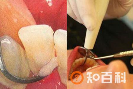 【图】清除牙石牙齿会损坏吗 说说洗牙的好处