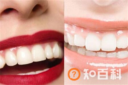 【图】暴牙修复后面部会发生微妙变化  可以提升颜值