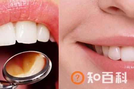 【图】清除牙石小妙招 早晚要刷牙不能偷懒