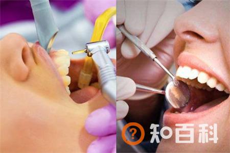 【图】洗牙好不好   可能存在安全隐患