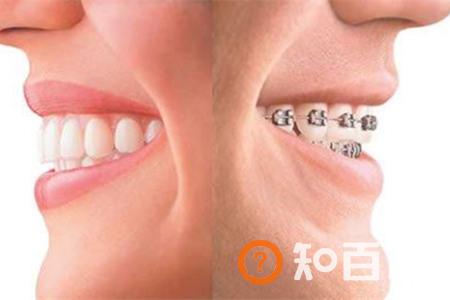 【图】暴牙的图片展示  强烈推荐几种矫正方法