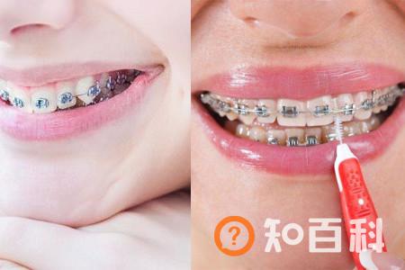 【图】矫正牙齿的危害居然有这么多 你都知道吗