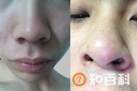【图】怎样让鼻头变小 哪些方法可以参考