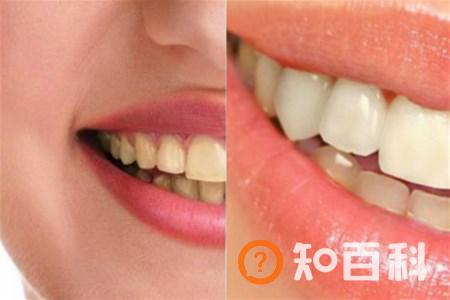 【图】如何清除牙石 3招让您拥有亮白牙齿